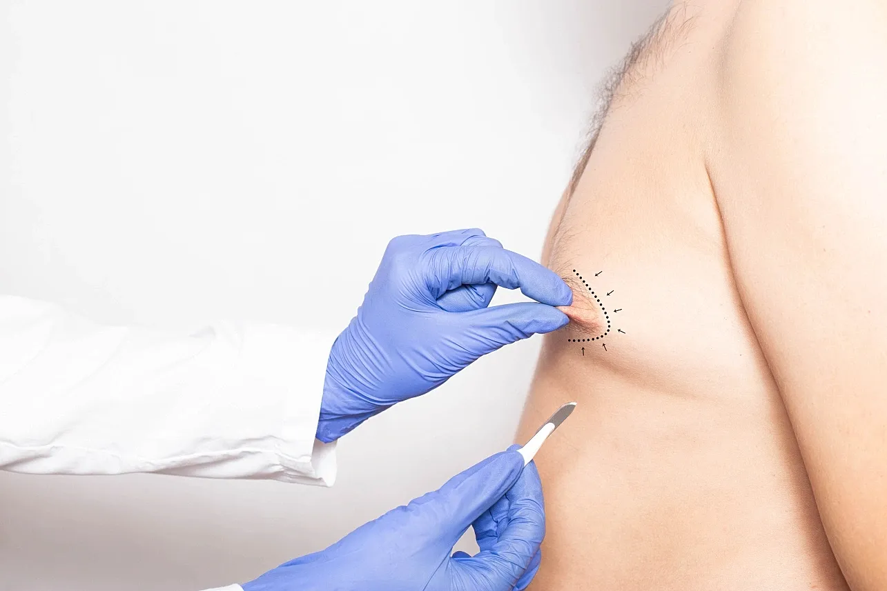 Gynecomastia Treatment: What to Expect Before, During, and After Surgery
