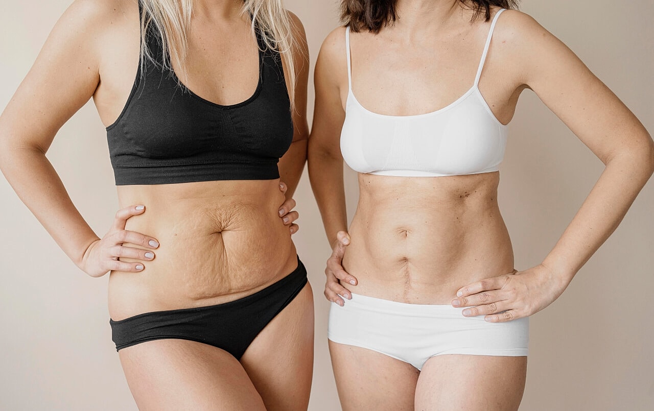 What Is The Difference Between a Tummy Tuck And Liposuction?