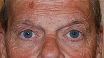 Blepharoplasty Before & After