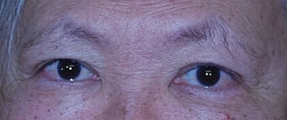 Blepharoplasty Before & After