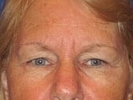 Blepharoplasty Before & After