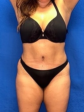 Tummy Tuck Before & After