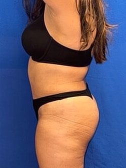 Tummy Tuck Before & After