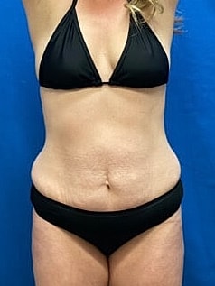 Tummy Tuck Before & After