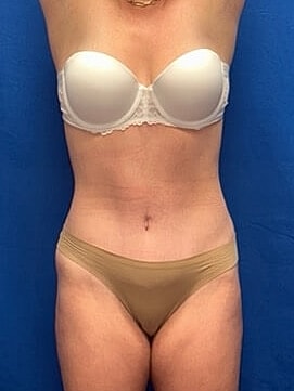 Tummy Tuck Before & After