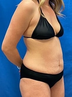 Tummy Tuck Before & After