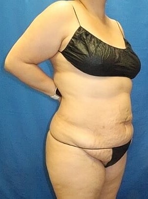 Tummy Tuck Before & After