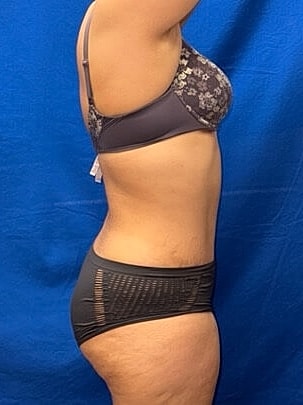 Tummy Tuck Before & After