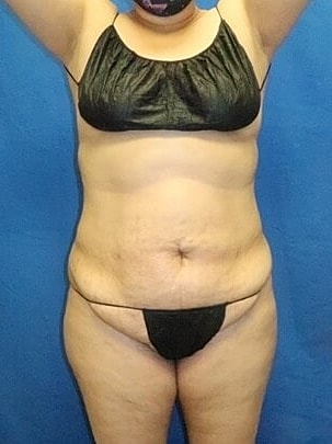 Tummy Tuck Before & After