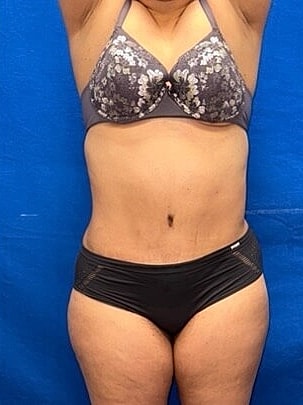 Tummy Tuck Before & After