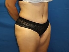 Tummy Tuck Before & After