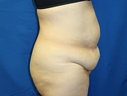 Tummy Tuck Before & After