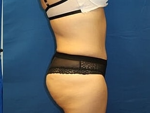 Tummy Tuck Before & After