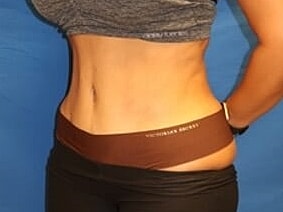 Tummy Tuck Before & After