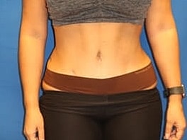 Tummy Tuck Before & After