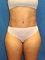 Tummy Tuck Before & After