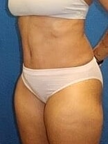 Tummy Tuck Before & After