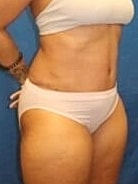 Tummy Tuck Before & After