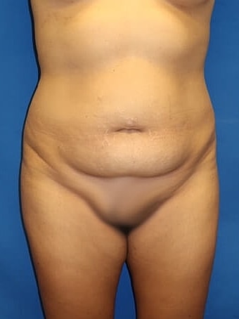 Tummy Tuck Before & After