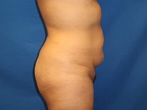 Tummy Tuck Before & After