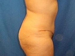 Tummy Tuck Before & After