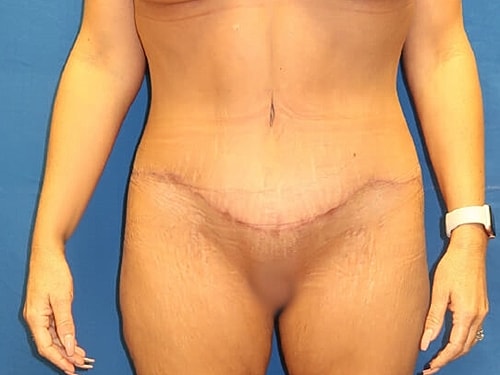 Tummy Tuck Before & After