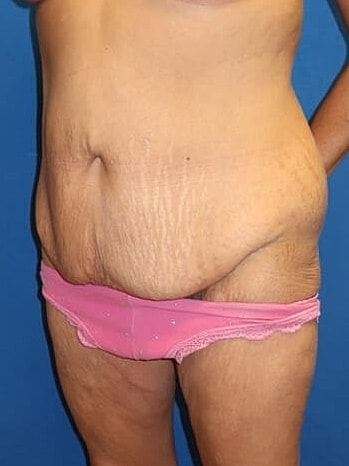 Tummy Tuck Before & After