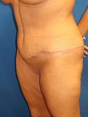 Tummy Tuck Before & After