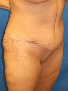 Tummy Tuck Before & After