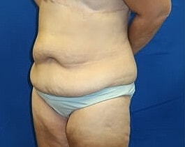 Tummy Tuck Before & After