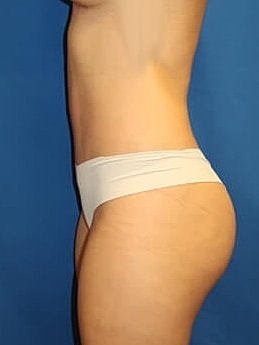 Tummy Tuck Before & After