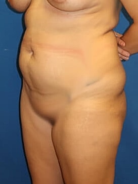 Tummy Tuck Before & After