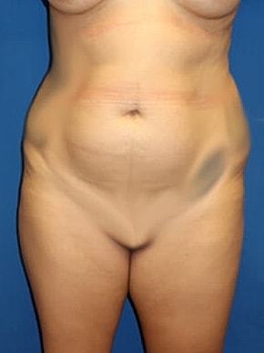 Tummy Tuck Before & After