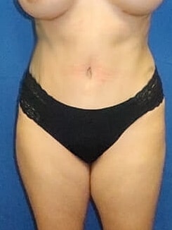 Tummy Tuck Before & After