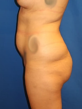 Tummy Tuck Before & After