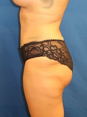 Tummy Tuck Before & After