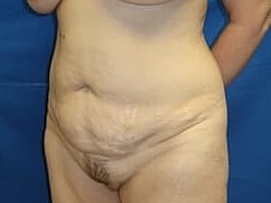 Tummy Tuck Before & After