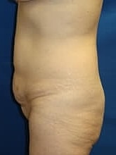 Tummy Tuck Before & After