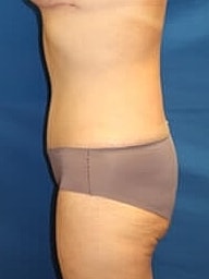 Tummy Tuck Before & After