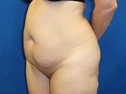 Tummy Tuck Before & After