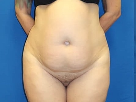 Tummy Tuck Before & After