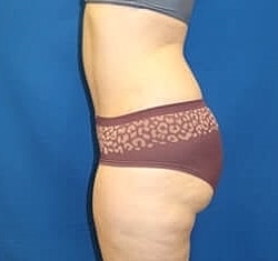 Tummy Tuck Before & After