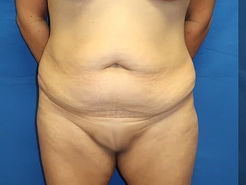 Tummy Tuck Before & After