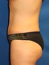 Tummy Tuck Before & After