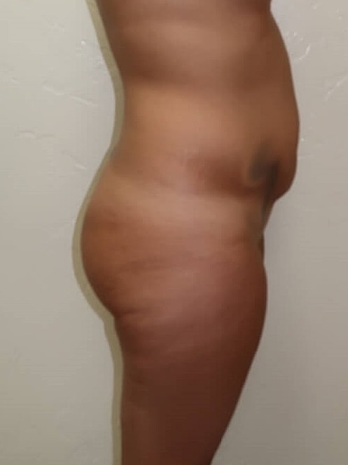 Tummy Tuck Before & After