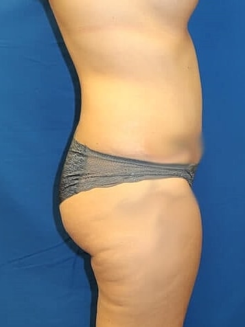 Tummy Tuck Before & After