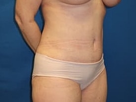Tummy Tuck Before & After