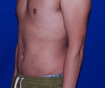 Tummy Tuck Before & After