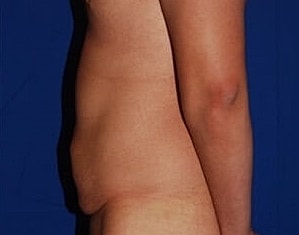 Tummy Tuck Before & After