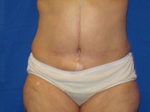 Tummy Tuck Before & After